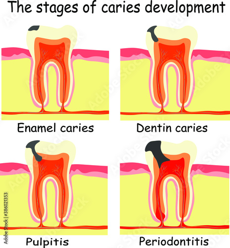 Stages of caries development. Enamel caries, Dentin caries, Pulpitis, and Periodontitis. Dental care info-graphic, illustration on white background.