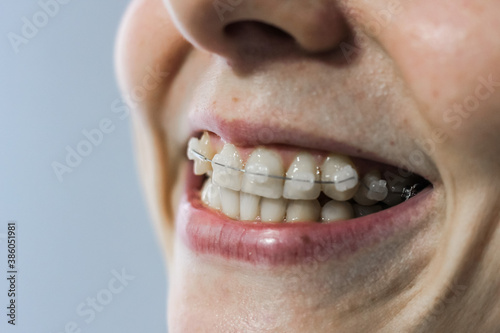 Orthodontic Treatment. Dental Care Concept. Braces system in smiling mouth. Closeup Ceramic and Metal Brackets. photo