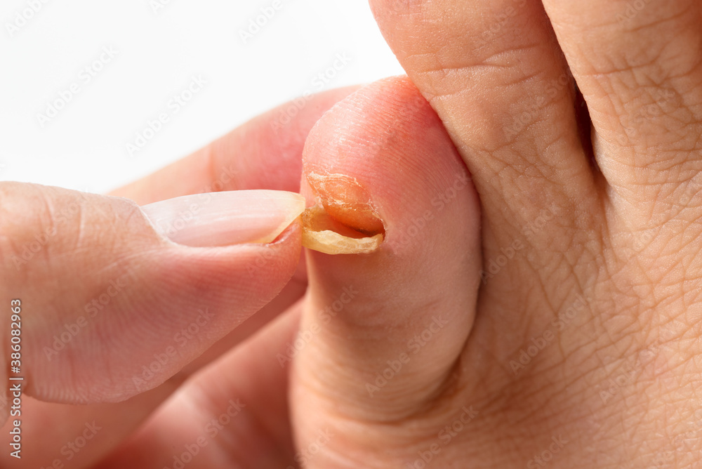 剥がれかけた足の小指の爪