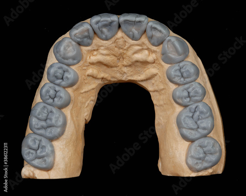 dental photography, dental photo, dentistry, macro photo, macrophotography, smile design, wax-up, dental wax-up, teeth, tooth, veneers