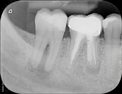 X-ray of two human tooth molars, both showing infections. One has an abscess and one has been root canal treated already and has a crown.