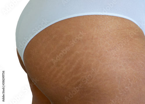 closeup stretch marks on woman buttocks, imperfect natural rough skin on Asian woman