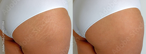 Image compare before and after Woman buttocks with stretch marks removal treatment, real people