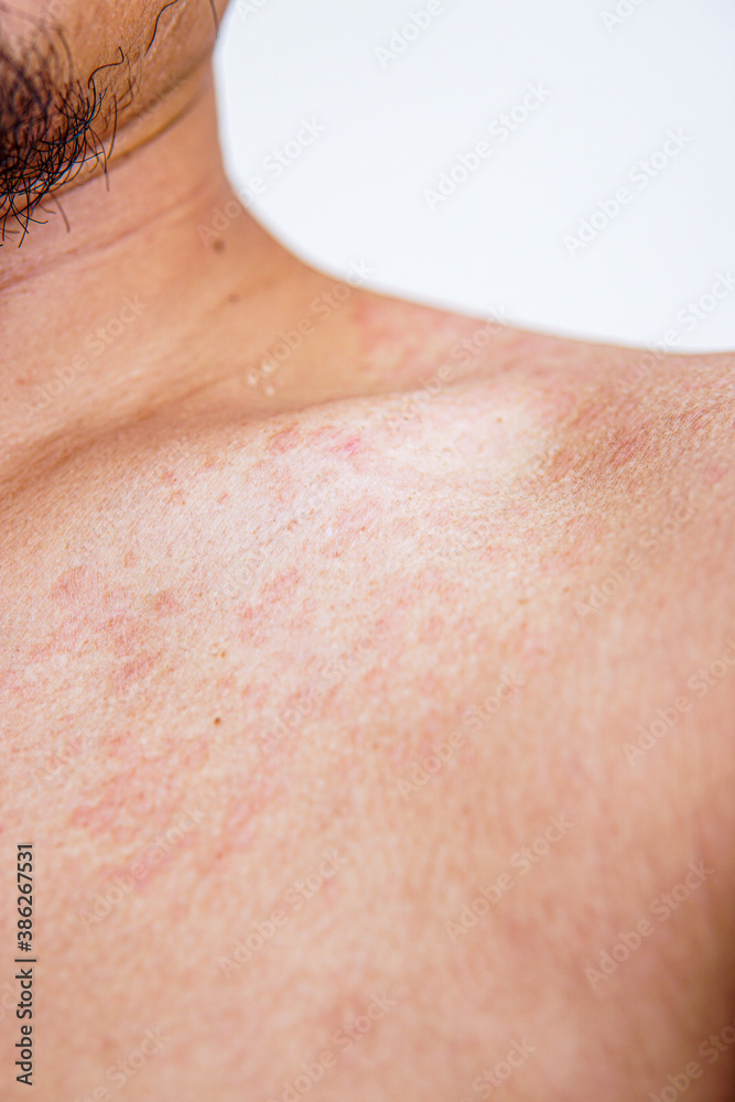 red inflamed skin on a man's body. skin fungus causing white blotches. Atopic eczema red inflamed skin on a man's body. skin fungus causing white blotches. Atopic eczema