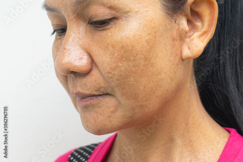 Woman problem skin face blemish on white background photo