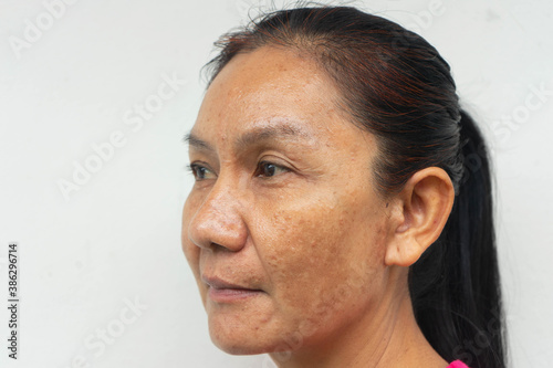 Woman problem skin face blemish on white background photo