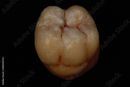 porcelain tooth, teeth, tooth, dental porcelain, dentistry, macrophotography, macro photo, dental photo, dentist, porcelain, e.max, ivoclar