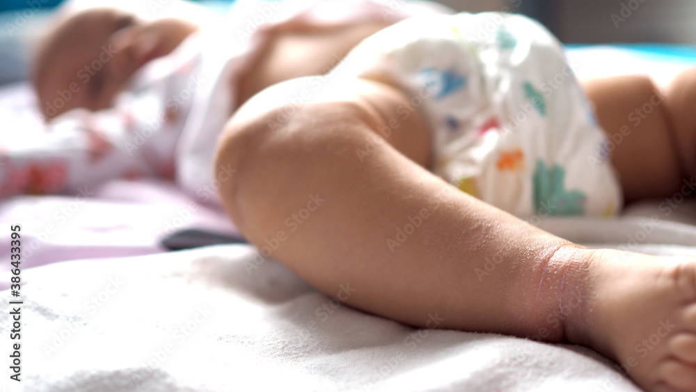 Close-up of the folds of the foot of a newborn baby with red skin. Atopic dermatitis of children's skin. Prickly heat. diaper rash. Close-up of the folds of the foot of a newborn baby with red skin. Atopic dermatitis of children's skin. Prickly heat. diaper rash.