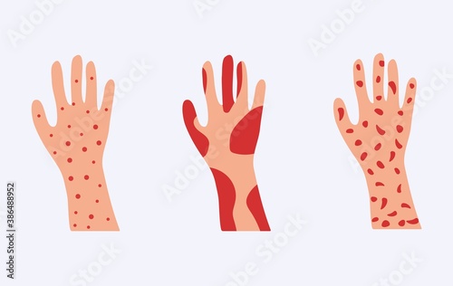 Skin allergy set. Hands covered red rash and scaling serious problems with psoriasis.