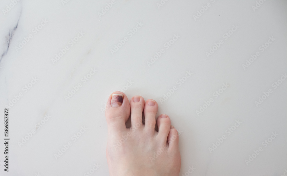 Toenails damaged by hematoma. Detachment of the nail, blow to the nail
