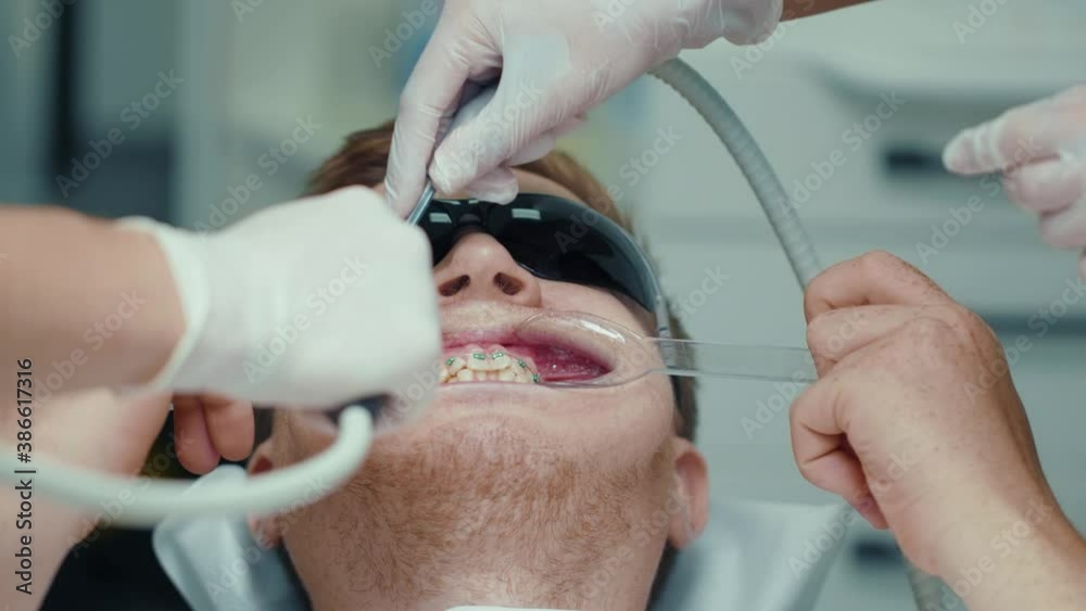 Vídeo do Stock Young dentist with special tools puts braces to man
