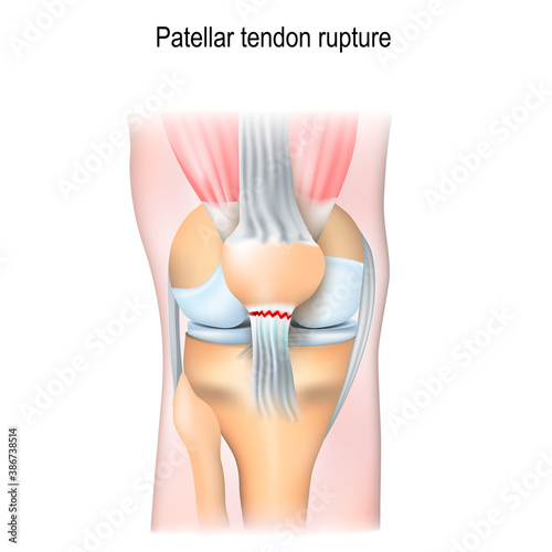 Patellar tendon rupture.