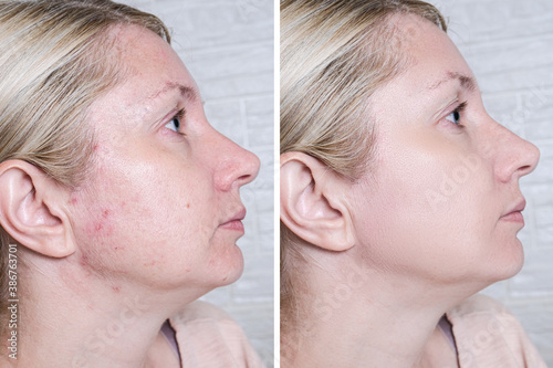 Young woman before and after anti acne treatment, skincare and dermatology concept