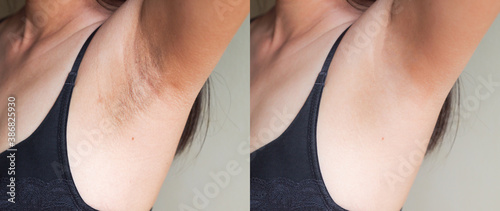 Image before and after skincare cosmetology armpits epilation treatment concept.Problem underarm chicken skin,Fox Fordyce,black armpit in woman. photo