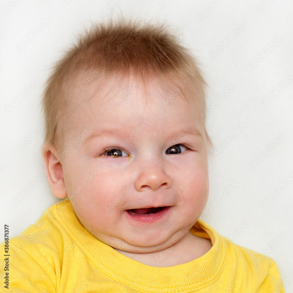 eye infection conjunctivitis in a newborn baby eye infection conjunctivitis in a newborn baby