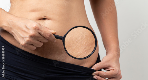 Quadro em tela Stretch Marks, Women Show off the belly after birth on white background