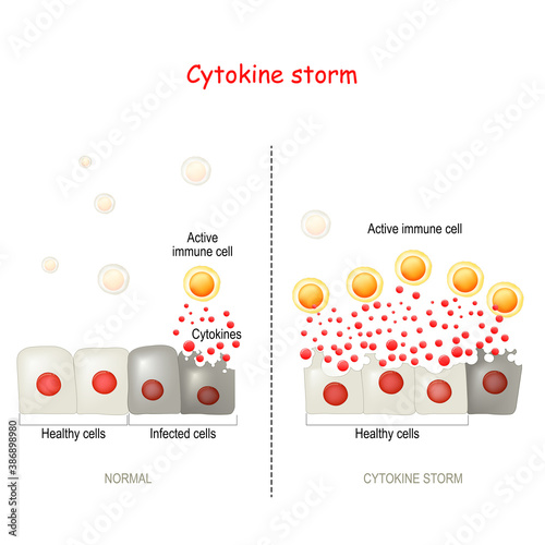 cytokine storm or hypercytokinemia. COVID-19 complications photo