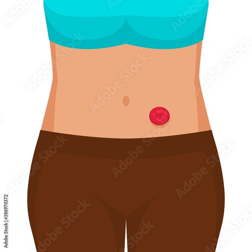 Young woman with stoma after colon cancer surgery