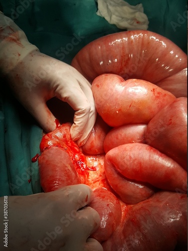 Anastomosis intestinal photo