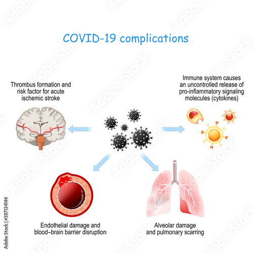 COVID-19 complications. coronavirus