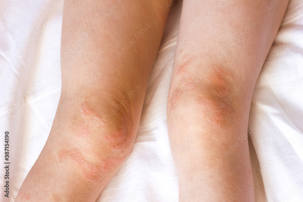 Manifestation of atopic dermatitis on the child’s body, rash redness and dry knees an allergic reaction Manifestation of atopic dermatitis on the child’s body, rash redness and dry knees an allergic reaction