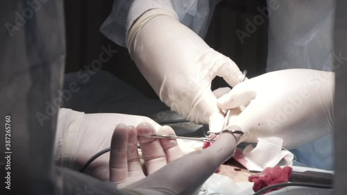 Close up of genitals of a patient who has testicular cancer. Action. Surgeons cutting out a tumor from male tescticle in the operating room in a hospital.