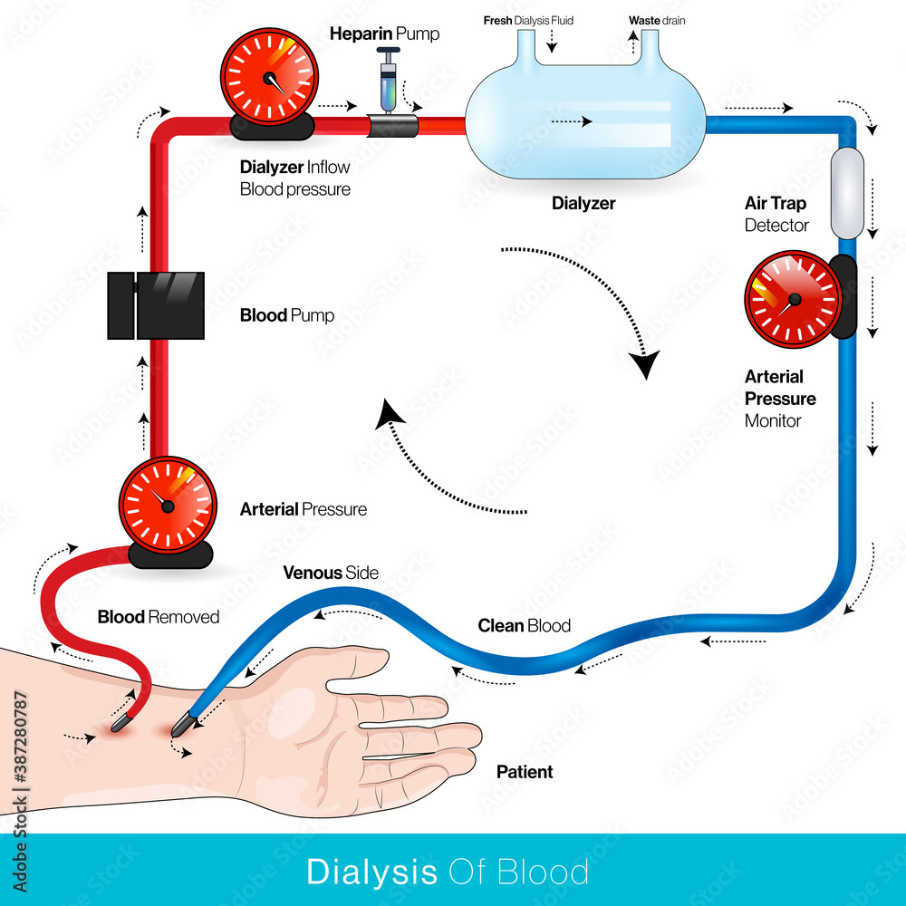 hemodialysis diagram