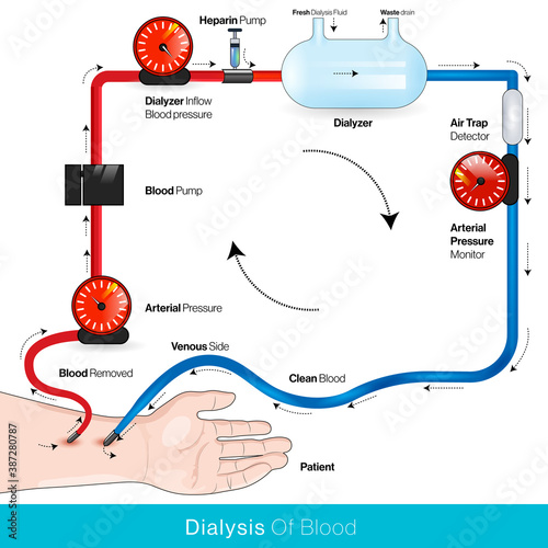 Hemodialysis or dialysis of blood chart vector inphograph