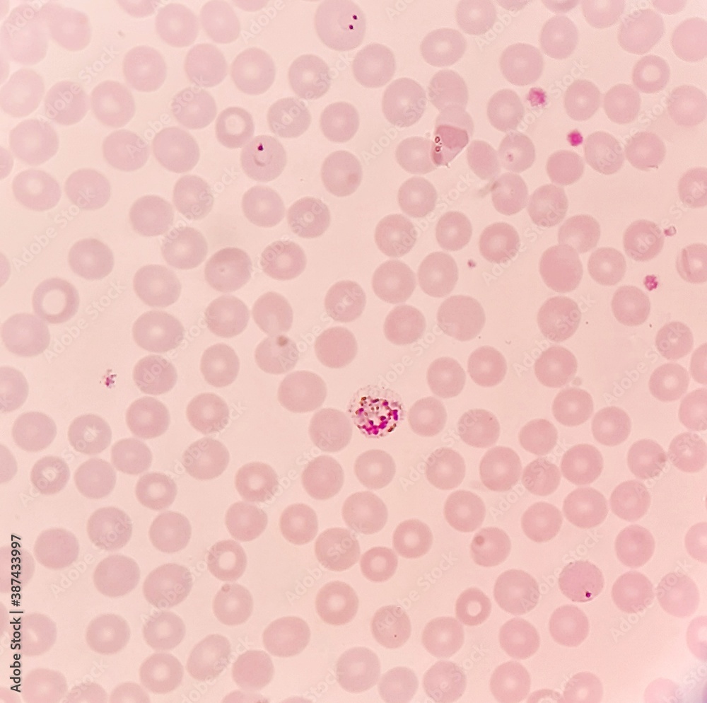 Under 100X light microscope, human parasite on thin film of blood smear with Plasmodium vivax trophozoite form malaria infected red blood cell, selective focus.
