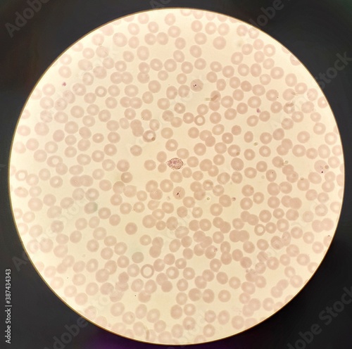 Under 100X light microscope, human parasite on thin film of blood smear with Plasmodium vivax trophozoite form malaria infected red blood cell, selective focus. photo