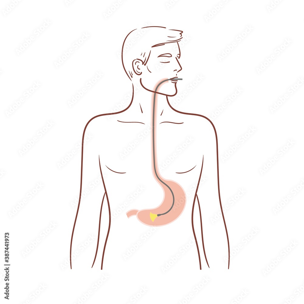 Fototapeta premium Gastroscopy of the stomach. Esophagoscopy,diagnostic procedure.A man is undergoing a medical examination. Stock isolated illustration on white background.