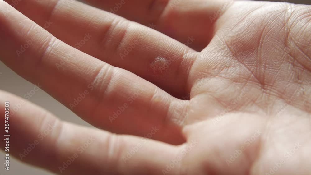 Dermatological problems on hand man skin closeup Dermatological problems on hand man skin closeup
