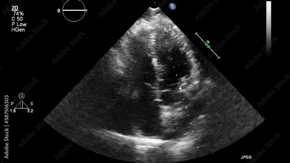 Transesophageal ultrasound video in gray-scale mode.