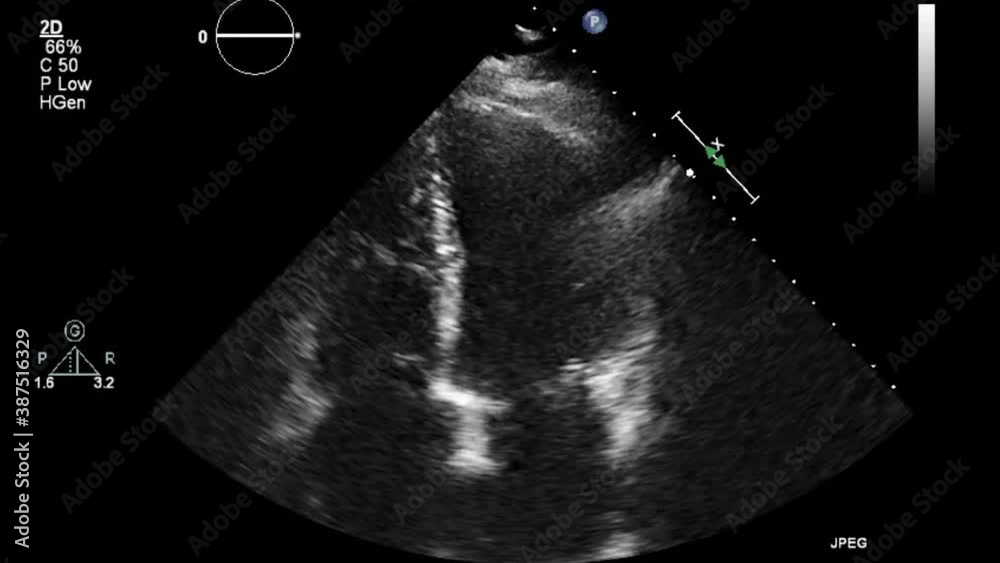 Transesophageal ultrasound video in gray-scale mode.