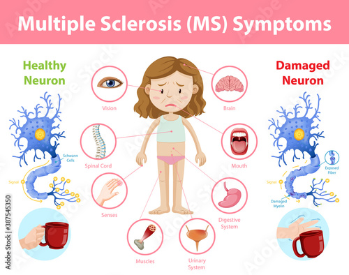 Multiple sclerosis (MS) symptoms information infographic
