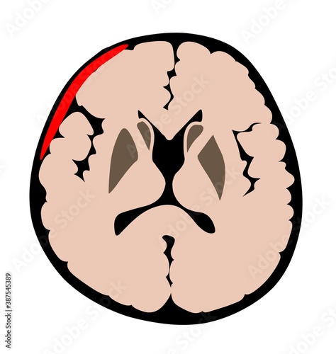 subdural hemorhage photo