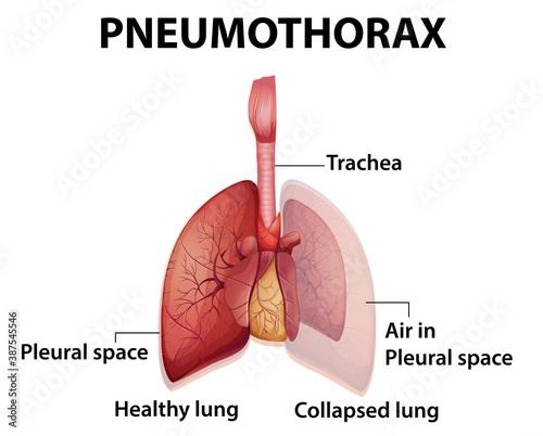 Informative illustration of Pneumothorax
