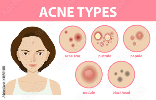 Types of acne on the skin or pimples