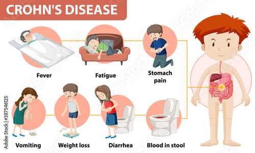 Medical infographic of Crohn's Disease photo