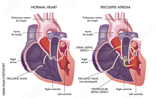 Quadro su tela Medical illustration that compare a normal heart with a heart affected by cardiac defect called Tricuspid Atresia, with annotations