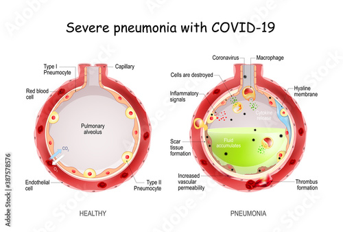 Severe pneumonia with COVID-19.