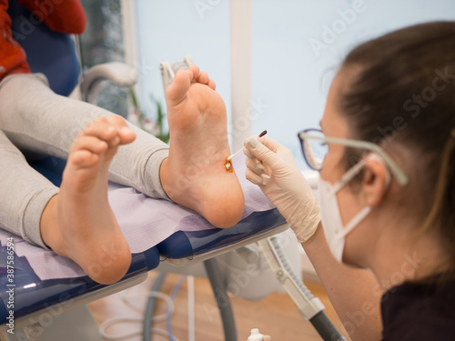 Podiatrist treating a wart verrucas plantar