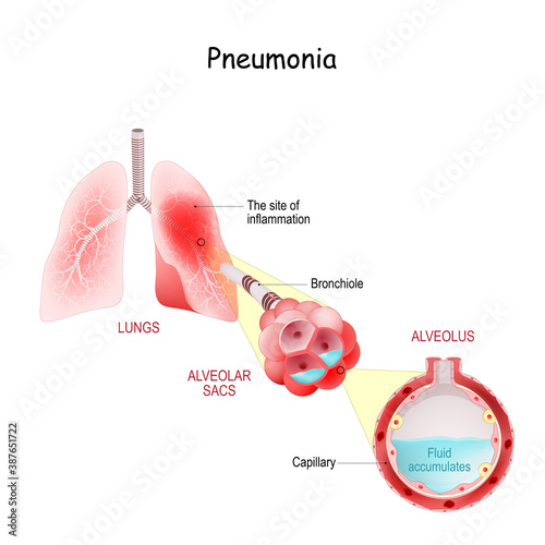 Cross section of Lungs Affected by coronavirus infection. COVID-19