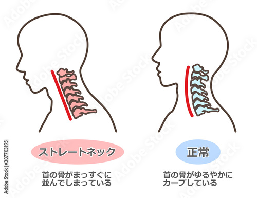 ストレートネック スマホ首 など