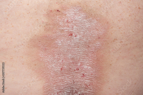 psoriasis: plaques, wounds, rashes, dry skin on the back of a psoriasis patient photo