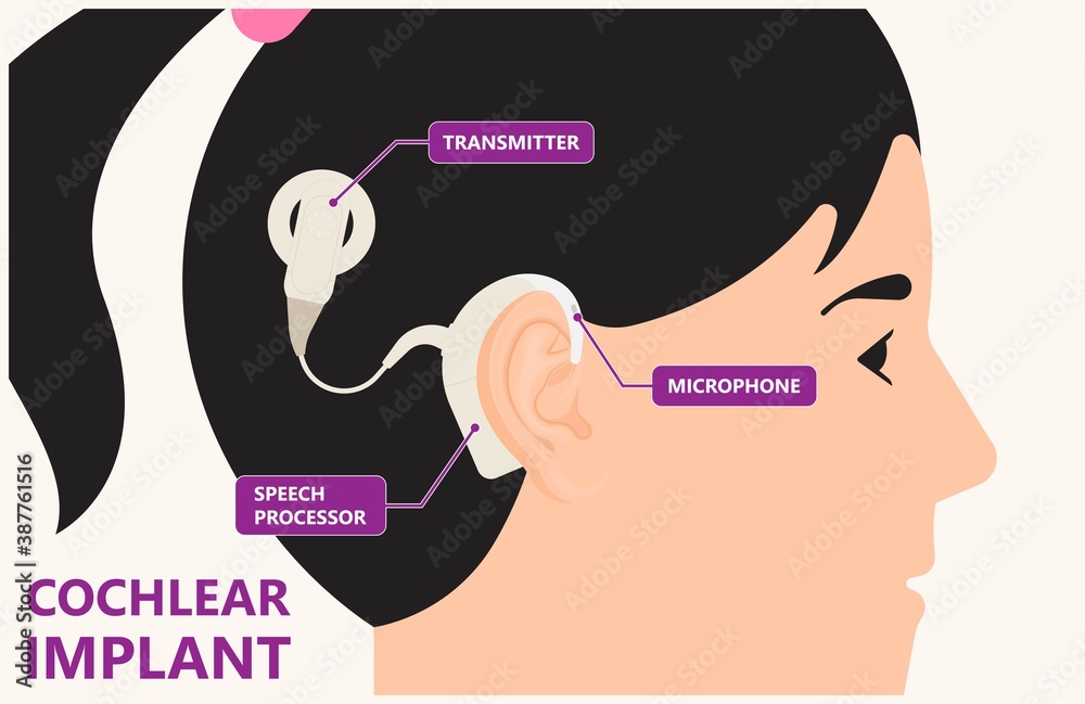 Obraz premium Cochlear implant device electrically stimulates nerve medical aid ear sound wave adults hard middle exam
