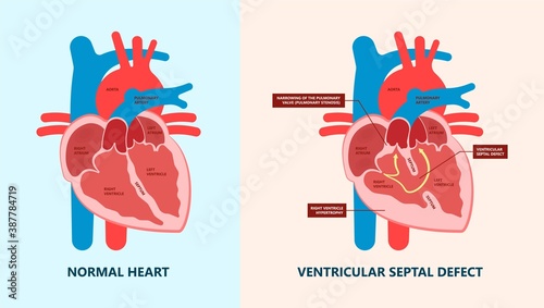 Cath Lab Atrial Septal Defect Tetralogy of Fallot Patent Foramen Ovale Mitral Valve Stenosis Heart Attack Ductus Arteriosus Doppler Coronary Artery Disease Congestive Congenital Valvular VSD exam leak