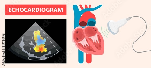 Cath Lab Atrial Septal Defect Tetralogy of Fallot Patent Foramen Ovale Mitral Valve Stenosis Heart Attack Ductus Arteriosus Doppler Coronary Artery Disease Congestive Congenital Valvular VSD exam leak