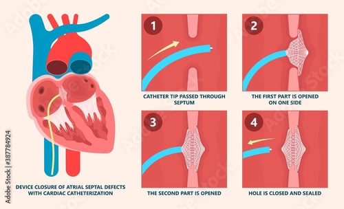 Cath Lab Atrial Septal Defect Tetralogy of Fallot Patent Foramen Ovale Mitral Valve Stenosis Heart Attack Ductus Arteriosus Doppler Coronary Artery Disease Congestive Congenital Valvular VSD exam leak