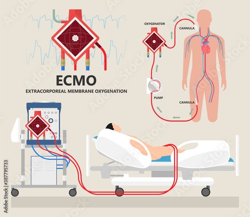 Extracorporeal membrane oxygenation ECMO a life support system for Respiratory failure patient system illness damage Infection perfusionist Ards transplant myocarditis embolism